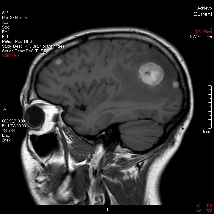 1st Brain MRI